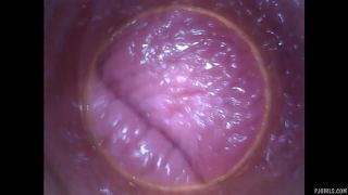 Silvie DeLuxe  RAW endoscopic video  2015-08-23l-8