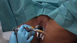 Spekula Bladder exam cystoscopy.-6