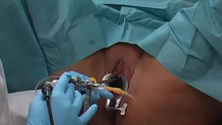 Spekula mov 84 Bladder exam cystoscopy (mp4)-6