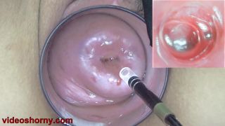 Cervix Endoscope Camera Insertion To Watch Inside Uterus in "Cervix Endoscope Camera Insertion To Watch Inside Uterus"  | speculum | webcam chastity fetish-1