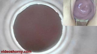 Cervix Endoscope Camera insertion to watch inside Uterus...-3