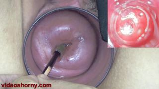 Cervix Endoscope Camera insertion to watch inside Uterus...-7