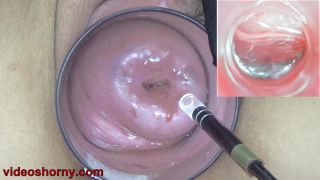 Cervix Endoscope Camera insertion to watch inside Uterus...-8